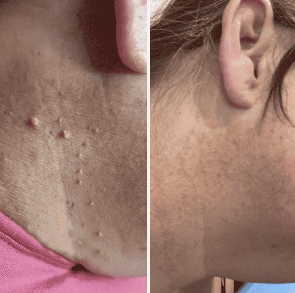 Lunova Clear Skin Tag Remover Kit