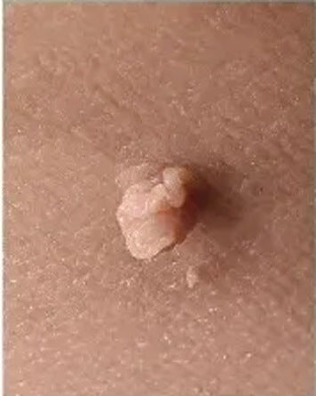 A skin tag before a band is applied